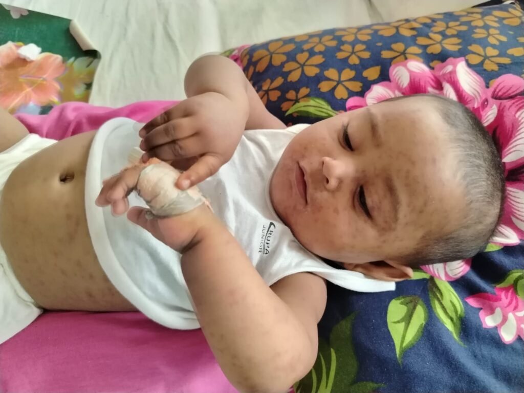 হামের হটস্পট যশোরে জরুরি টিকাদান শুরু লক্ষ্যমাত্রা ৯১ হাজার 1 WhatsApp Image 2026 04 05 at 4.04.51 PM